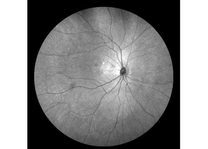 Ultra-wide Field Laser Scanning Retina Angiograph Digital Ophthalmic Equipment With Optical Zoom 100°/60°/30°