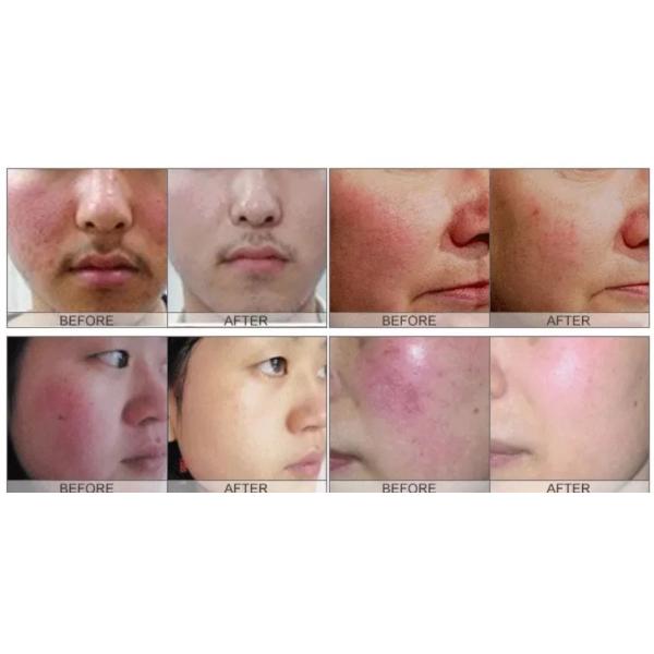 Spider Vein Removal Vascular Removal 980Nm Diode Laser Machine For Spa Salon Use Equipment