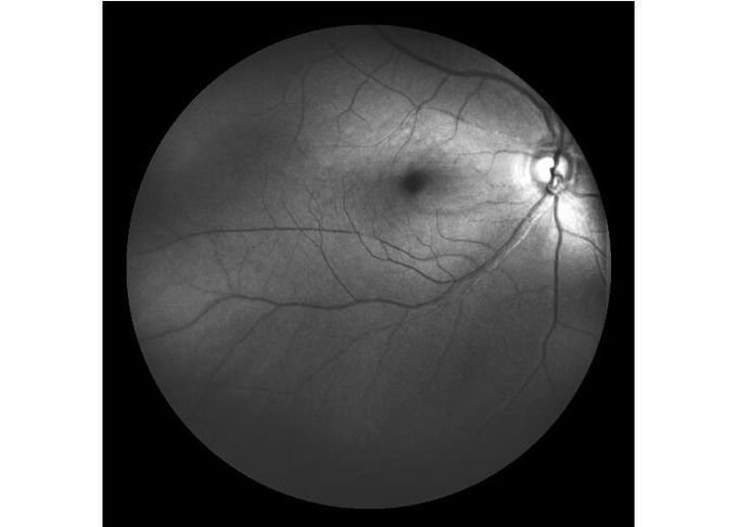 Ultra-wide Field Laser Scanning Retina Angiograph Digital Ophthalmic Equipment With Optical Zoom 100°/60°/30°
