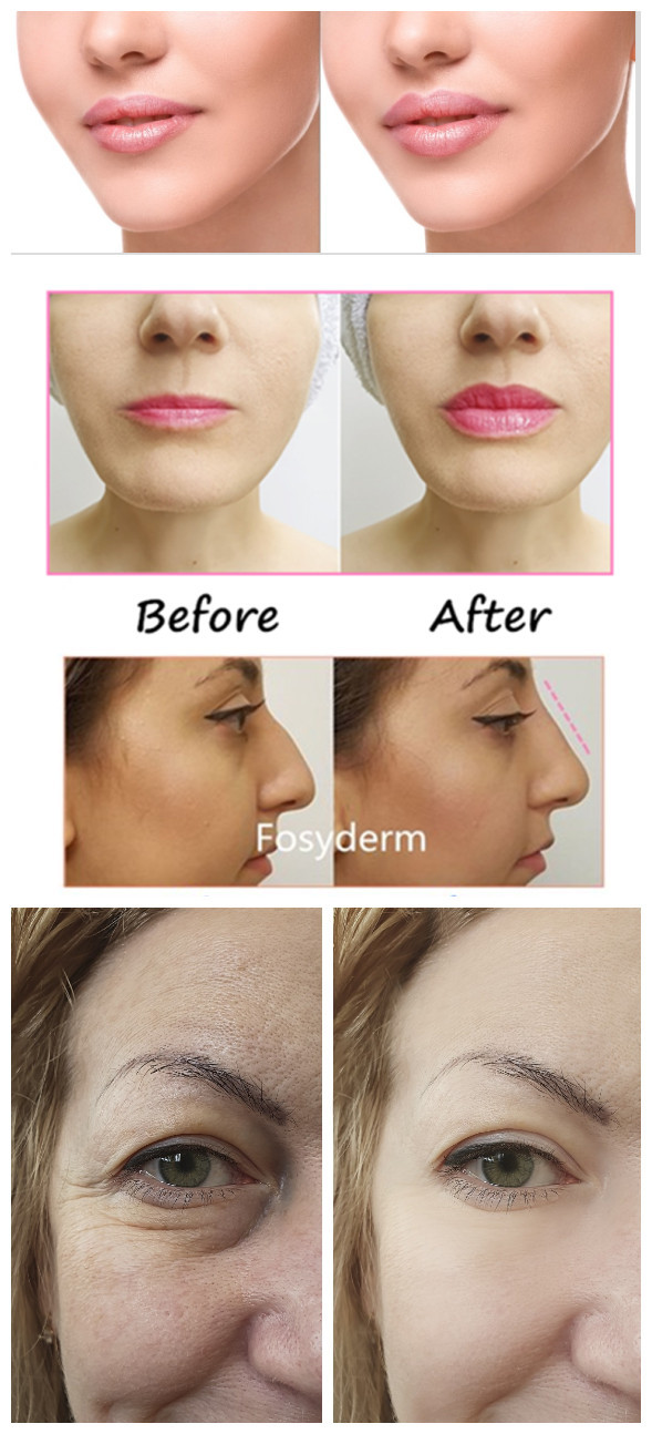 Fosyderm Hyaluronic Acid Lip Fillers Skin Care Product For Hyaluron Pen Use