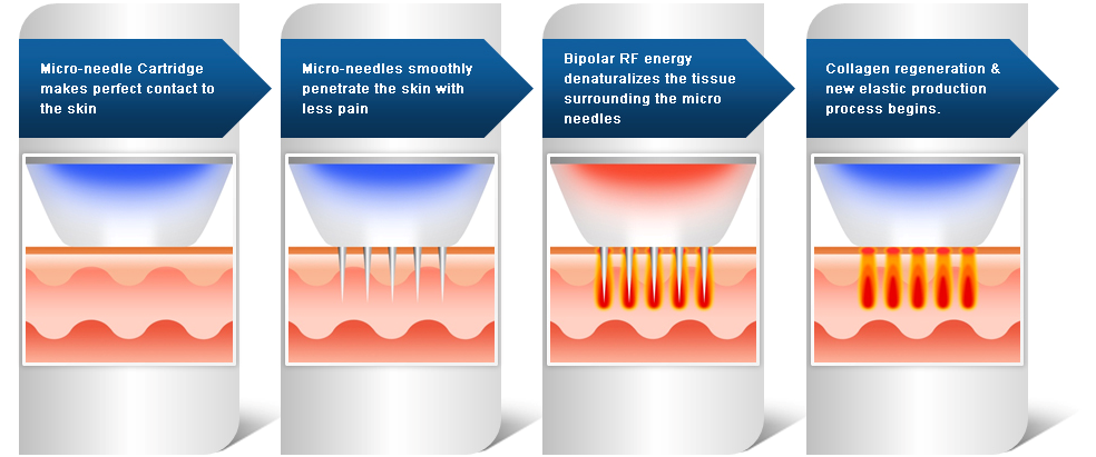 Microneedling RF /RF Lifting/ Fractional RF Skin Tightening Machine