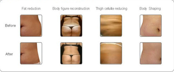 cryolipolysis/cryolipolysis slimming machine,fat freezing machine