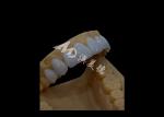 Prosthetic Dentistry Zirconia Dental Crown Precise Fit Aesthetics For full arch