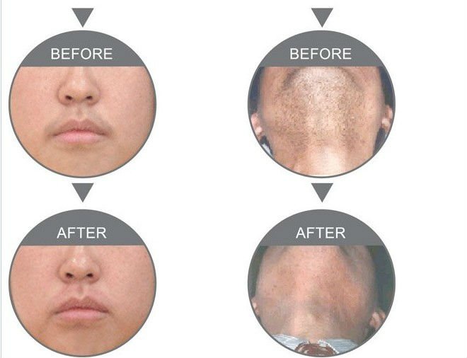 Professional IPL hair removal and skin rejuvenation beauty machine /equipment pz laser PZ102 ipl machine