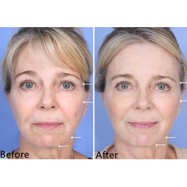 5ml Poly L Lactic Acid Filler Injectable Dermal Filler 3D PLLA