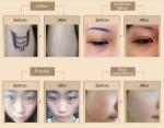 1064nm/532nm Nd YAG laser, Picosecond laser all colour tattoo removal machine