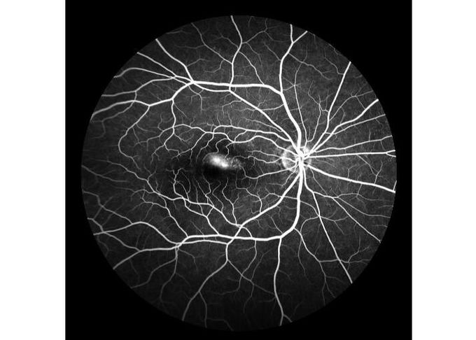 Ultra-wide Field Laser Scanning Retina Angiograph Digital Ophthalmic Equipment With Optical Zoom 100°/60°/30°