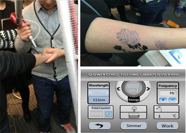 Tattoo Removal Machine professional nd yag laser tattoo removal machines