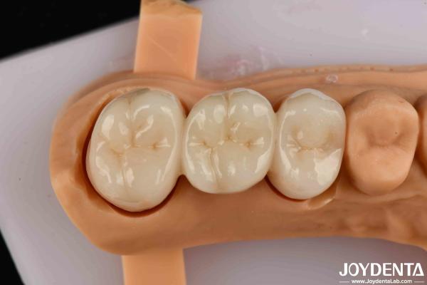 High Flexural Strength Full Contour Zirconia For Crowns Bridges Dental