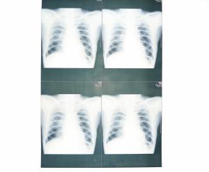 Wholesale 20cm x 25cm Medical Diagnostic Imaging , Laser Printer Film X Ray Paper from china suppliers