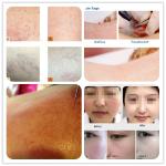 LEADBEAUTY beauty devices for painless treatment laser vein removal
