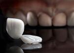 Translucency Porcelain Emax Veneer for Excellent Fit / Natural Esthetics
