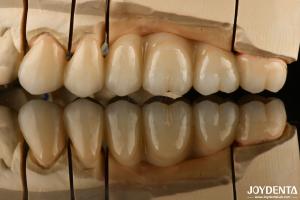 Wholesale Natural Looking Multilayer Full Zirconia For Dental Restorations Ultra Translucent from china suppliers