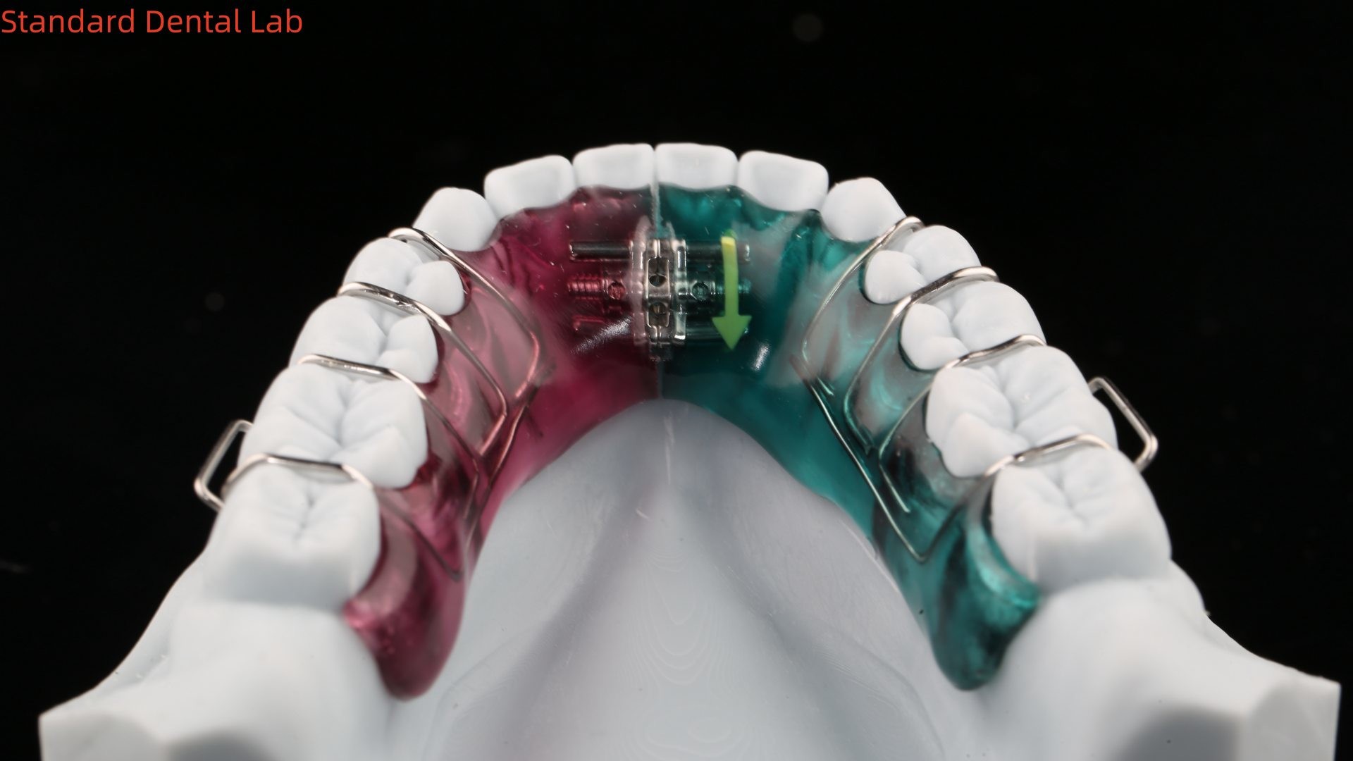 Teeth Expansion And Distalization Orthodontist Palate Expander China Dental Lab