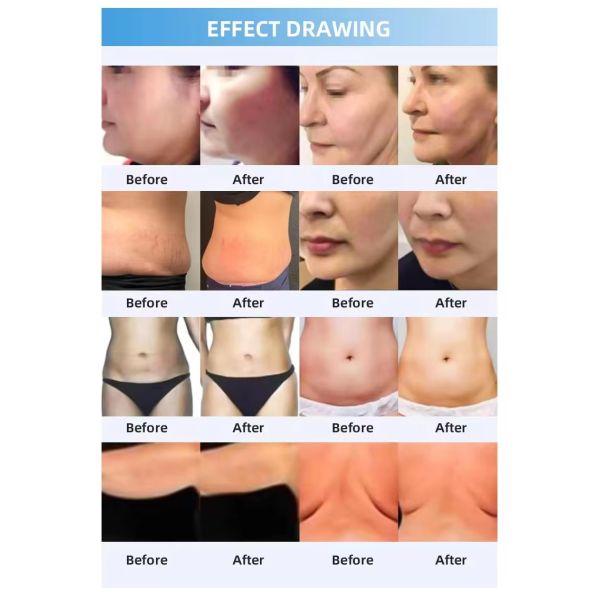 Professional Cryo Slimming Equipment Cold Therapy Body Shaping and Skin Tightening Machine