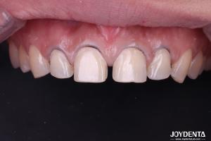 Wholesale Real Looking Dental Porcelain Veneers Perfectly Fit Ceramic Teeth Veneers For Front Teeth from china suppliers