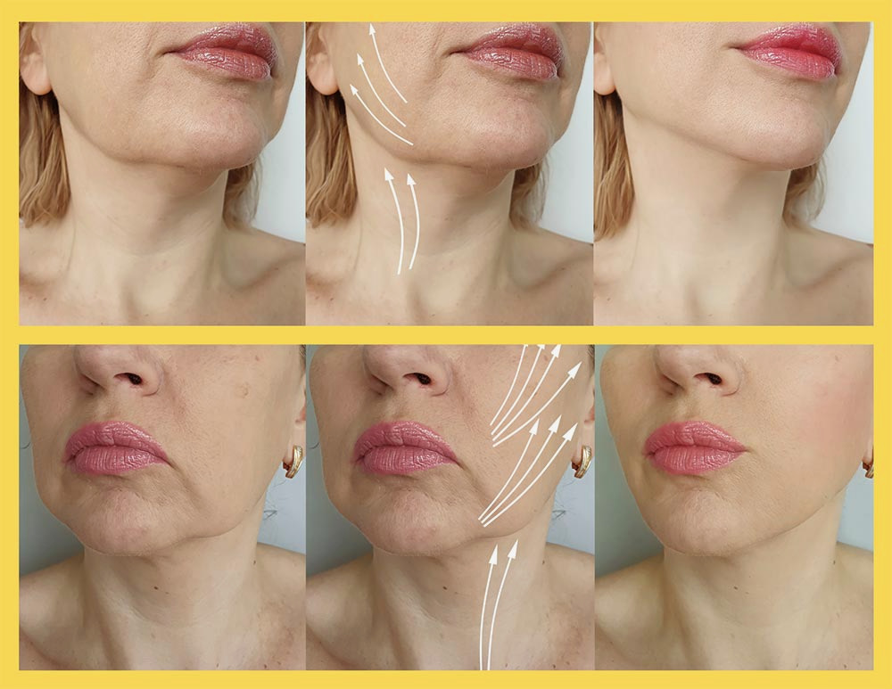 Korea Cog 3D Thread PDO Thread Lifting For Face Sterile Packaging