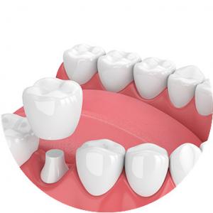 China Beautiful Dental Crowns And Bridges Smooth Surface For Oral Hygiene Safety on sale