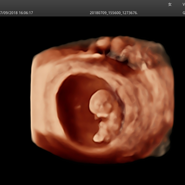 Sonoscape S60 Ecografo Sonoscape Ultrasound Machine Cw Tdi Software For Free