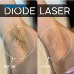 Ice Speed L 3 Wavelength Oem Commercial 808 Diode Laser Hair Removal Machine