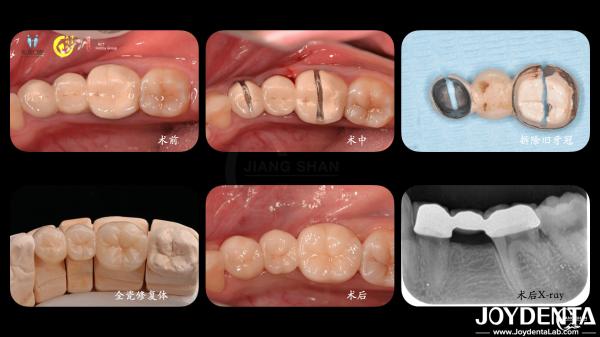 Tailored Dental Zirconia Crown Biocompatibility Comfort Customization For