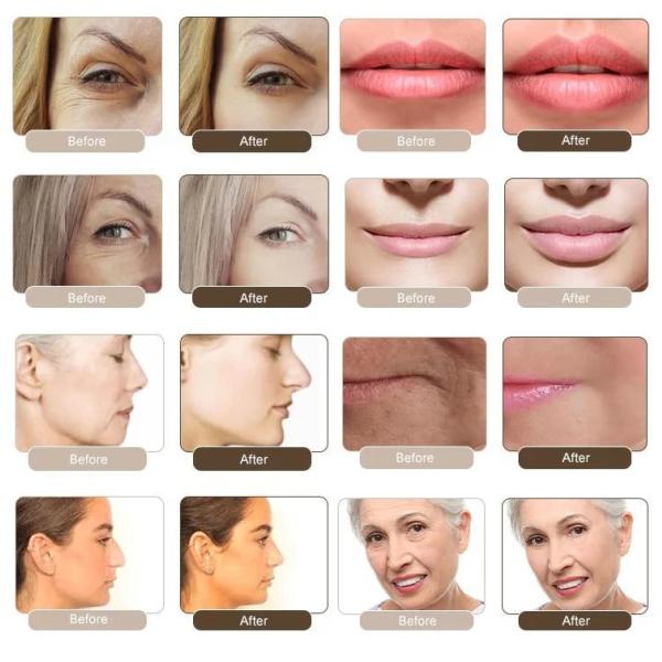 1.1ml Revolax Deep Hyaluronic Dermal Filler For Face