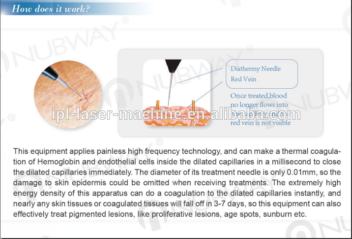 CE Approval 30MHZ High Frequency Non-invasive Vein Stopper Portable Spider Vein Removal Machine on sale.png