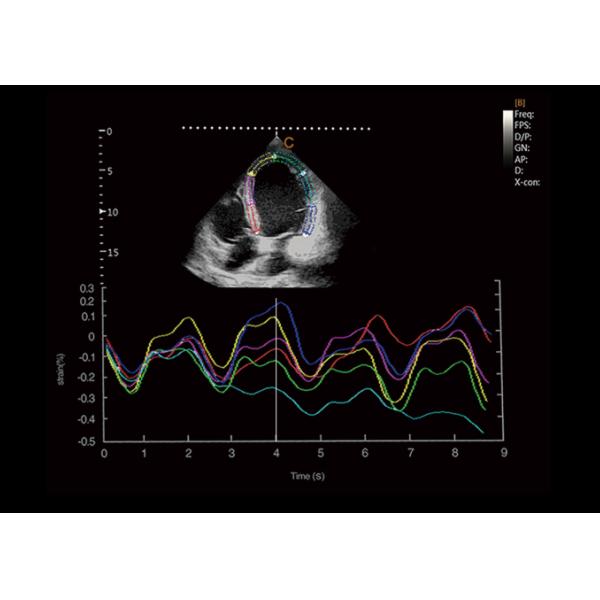 Cart-Based Chison Ultrasound Machine Xbit 90 With Auto EF Function
