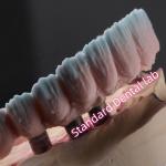 Zirconia Implant Bridge Screw Retained With Pink Gum Porcelain
