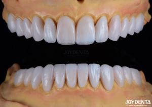 Wholesale Custom Crafted Emax Porcelain Veneers Smooth Texture Dental Restorations from china suppliers