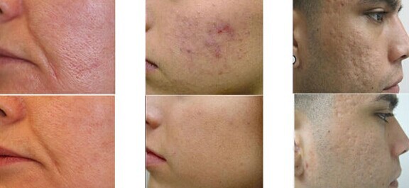 Super Pulse Fractional CO2 Laser Machine For Spot Laser Removal