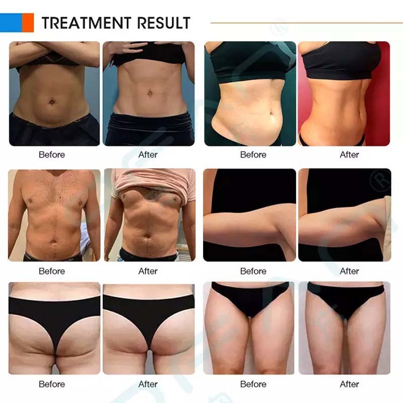 4 Handles Body Slimming Machine Screen 15.6 Inch Cool Sculpting Magnetic Thin Muscle Building