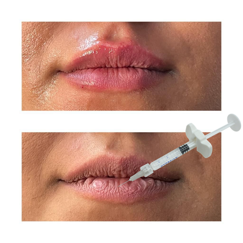 Dermal Lip Fillers Safe Effective For Medical Professionals