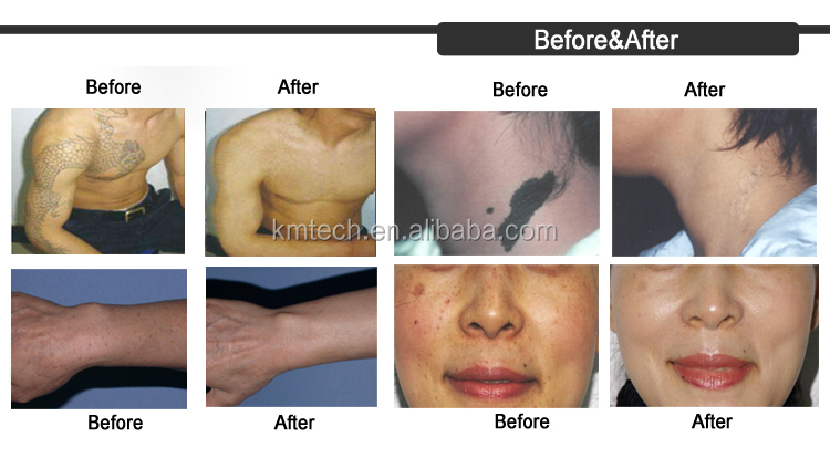 2000W Picosecond Laser Equipment , Pico Laser Device For Tattoo Removal