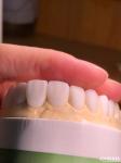 Customized Digital Diagnostic Wax Ups for Natural Tooth Anatomy Replication