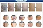Good Price!! Beauty Device Tattoo Remove Laser Machine/Q Switch ND Yag Laser