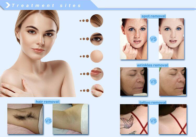 Medical OPT SHR Machine Aesthetic Beauty Salon Devices ROHS Certification
