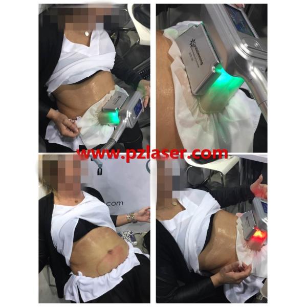 Medical CE TUV Fat Freezing Machine For Home With 4 Handles High Efficiency