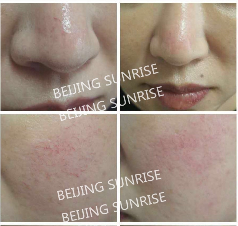 pain relief Laser device/ agents wanted cold laser