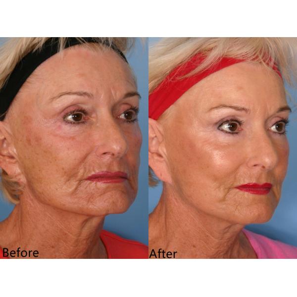 5ml Poly L Lactic Acid Filler Injectable Dermal Filler 3D PLLA