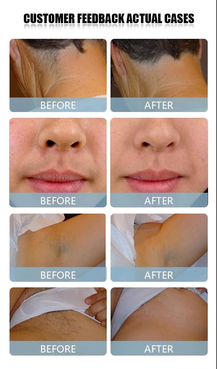 diode laser 808nm hair removal machine for sale / 808nm diode hair removal laser equipment LF-647A