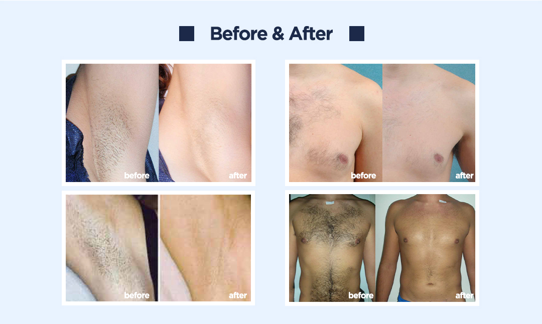 Diode Laser 755 808 1064 Hair Removal Painless