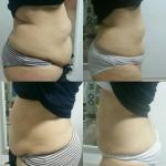 RF Cavitation Slimming Machine Vacuum Roller Skin Tightening