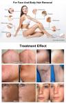 QY-BT310 Powerful 1000W Diode Laser 755 808 1064 Diode Hair Removal Laser