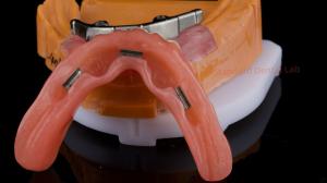 Wholesale Ivoclar Digital Dental Implant Bar Denture with Attachments Full Acrylic Denture Titanium Implant Supported Dentures from china suppliers