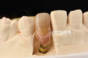 Wholesale 0° Angulation Finished Dental Abutments 1.5mm Thread Pitch Polished Surface from china suppliers