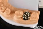 Abrasion Resistant Wax Casting Dental Materials for Enhanced Oral Rehabilitation