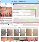 Painless gentle yag laser 1064 nm 532nm pigments tattoo removal q switch nd yag