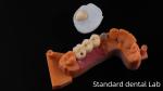 Post Core Dental Lab from China / Metal Post Core with PFM Crown