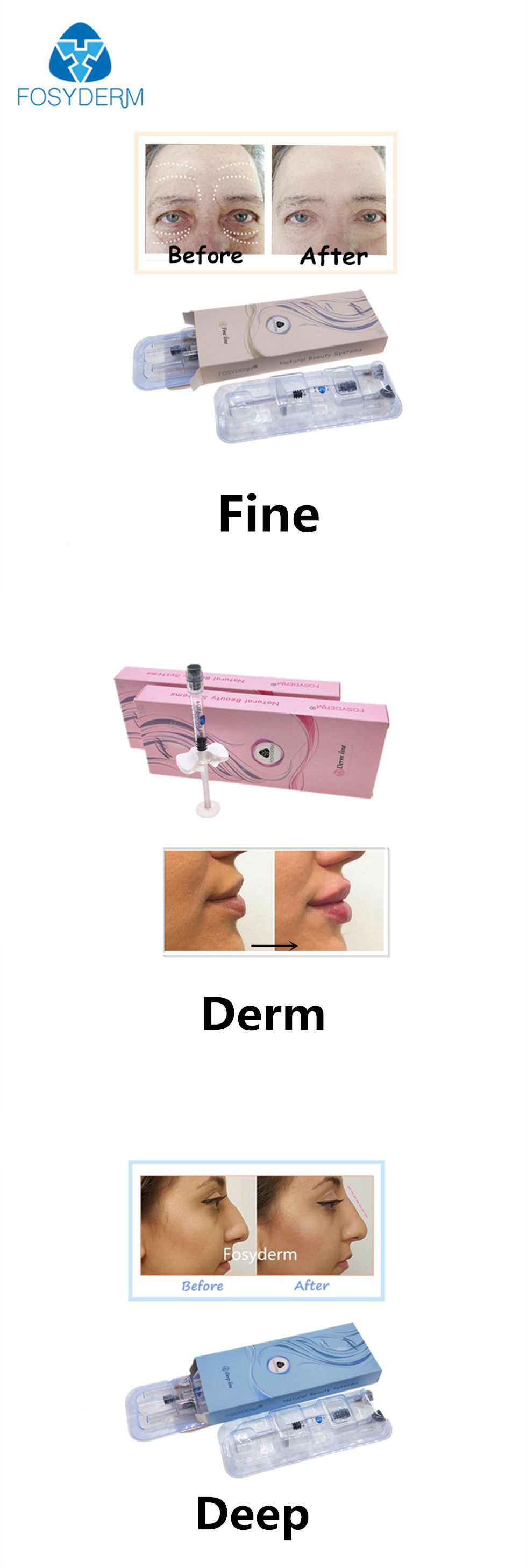 Crosslinked HA Hyaluronic Acid Dermal Filler With Pre Filled Syringe
